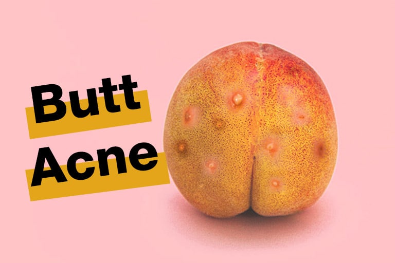 8 Butt Acne Tips - How To Get Rid Of Pimples On Your Butt