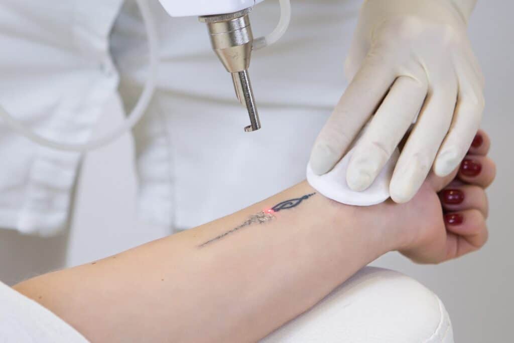 tattoo removal clinic singapore
